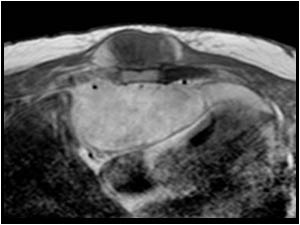 Axial MRI image shows the extension of the mass.