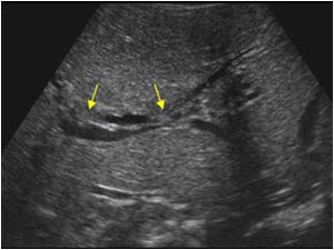 Transverse image of the liver with dilatated intrahepatic bile ducts with intraluminal reflective structures (arrows)
