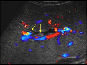 Transverse image of the liver with color doppler confirming absent flow in the intrahepatic ducts. The arrows point to intraluminal structures in the biliary ducts.