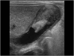 Longitudinal image of the gallbladder with intraluminal material