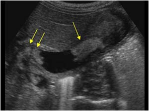 Longitudinal image of the gallbladder with intraluminal masses also in the neck (double arrows) with the same echogenicity as the structures in the intrahepatic ducts.