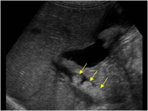Longitudinal image of the common bile duct showing 3 rounded intraluminal structures