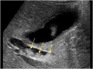 Another longitudinal image of the common bile duct showing multiple rounded intraluminal structures.