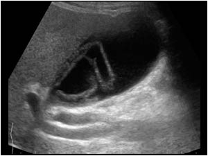 Longitudinal image of the gallbladder with a membranous structure