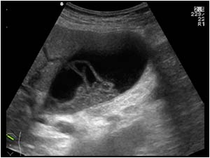 Longitudinal image of the gallbladder with sludge and the same membranous structure
