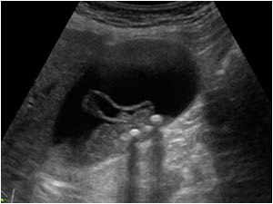Longitudinal image of the gallbladder with gallstones, sludge and the same membranous structure