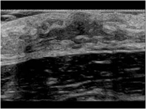 Hypoechoic lesion behind the left nipple