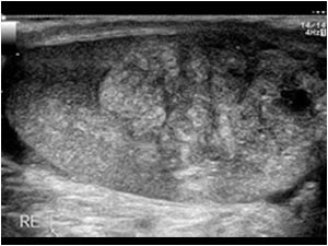 Longitudinal image of the enlarged right testis with an inhomogeneous mass