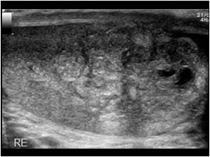 Longitudinal image of the enlarged right testis with cystic areas in the testicular mass
