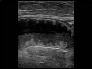 Longitudinal image of one of these ring-like structures shows a small bowel loop filled with fluid and sedimentation of bowel contents