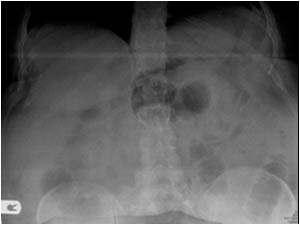 The plain abdominal X ray shows a dilatated bowel loop in the midline of the upper abdomen