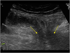 A lower frequency image shows an abdominal wall hernia through which small bowel loops protrude.