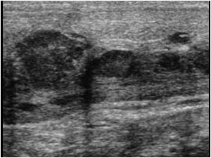 Longitudinal image of the penis with multiple irregular hypoechoic masses