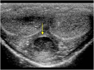 Transverse image of the penis with a hypoechoic mass