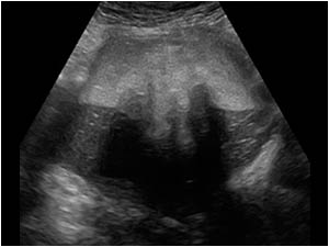 Transverse image of the palpable mass shows a lesion with mixed densities. There is a layering of the contents suggesting differences in specific gravity. The lesion shows no vascularity with color Doppler.