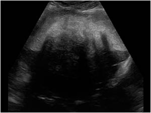 Transverse image of the palpable mass a little more cranial to image 1 shows a large hyperechoic area with acoustic shadowing central within the mass.