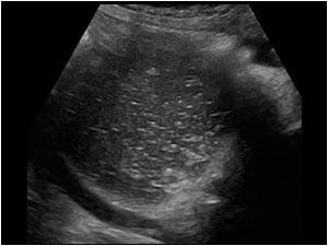 Longitudinal image with the patient in the left lateral decubitus position shows fluid with internal echoes in the mass.