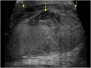Longitudinal image of the testis with an intratesticular hematoma and a hematocele