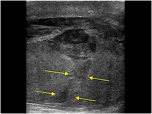 Detail of the testis with a hypoechoic linear lesion consistent with a testis fracture (arrows)