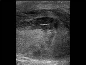 Longitudinal image of the fractured testis with testis hematoma and hematocele