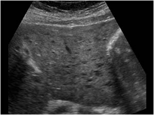 Diffuse small hypoechoic liver lesions