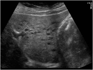 Diffuse small hypoechoic liver lesions in the left liver lobe