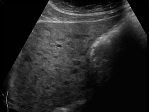 Diffuse small hypoechoic liver lesions in the left liver lobe