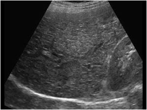 Diffuse inhomogeneous liver parenchyma that biopsy proved to be caused by periportal fibrosis