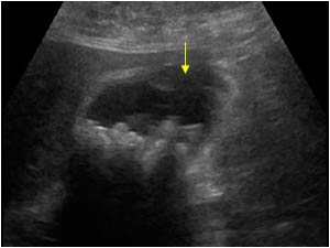 Cholecystitis with a perforated gallbladder wall