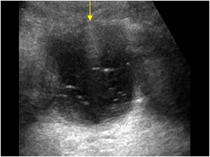 Thick walled bladder with debris and air transverse