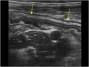 Thickened ileal wall