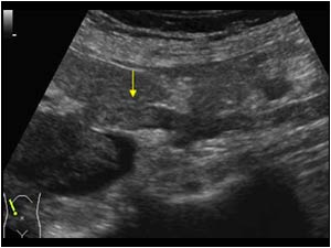 Tumor thrombus in the right ovarian vein longitudinal