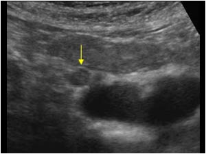 Tumor thrombus in the right ovarian vein transverse