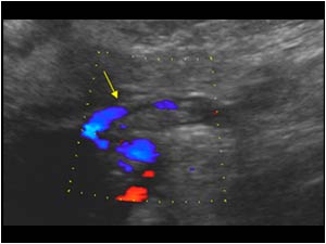 Flow along the tumor thrombus in the right ovarian vein longitudinal