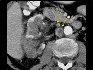 Tumor in the vena cava and ovarian vein