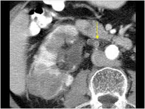 Tumor thrombus extending in the right ovarian vein
