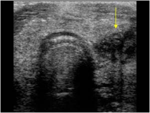 Hypoechoic mass in the left thyroid lobe transverse