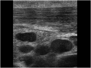 Inflamed sternocleidomastoid muscle and cervical lymphadenopathy