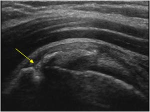 Calcific tendinitis penetration of the cortex of the greater tubercle