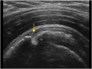 Calcific tendinitis penetration of the cortex of the greater tubercle
