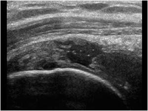 Large full thickness suprasinatus tendon rupture longitudinal