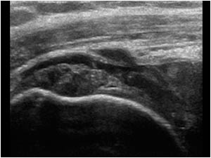 Suprasinatus tendon rupture during compression longitudinal