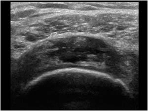 Large full thickness suprasinatus tendon rupture transverse