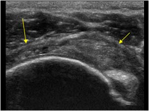 Supraspinatus tendon rupture with small intact anterior part next to the biceps tendon