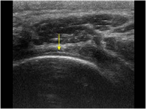 Complete rupture of the infraspinatus tendon and naked cartilage