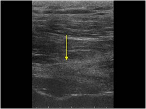 Atrophy of the supraspinatus muscle