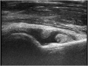 Effusion and synovial thickening in the coronoid fossa longitudinal