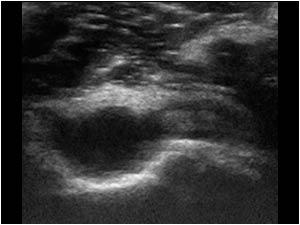 Effusion and synovial thickening in the coronoid fossa transverse