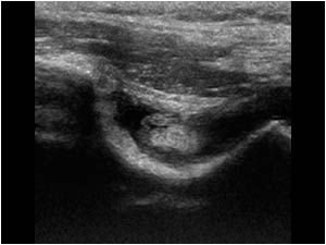 Effusion and synovial thickening in the olecranon fossa transverse