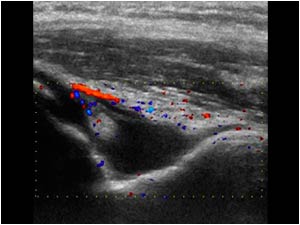 Effusion and synovial thickening in the olecranon fossa longitudinal